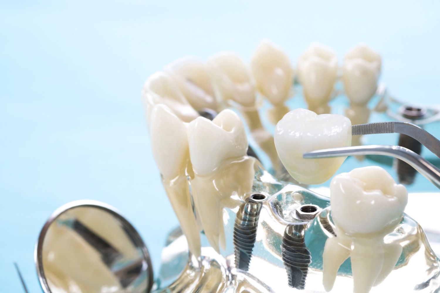 Protetyka stomatologiczna: Klucz do zdrowego i pięknego uśmiechu